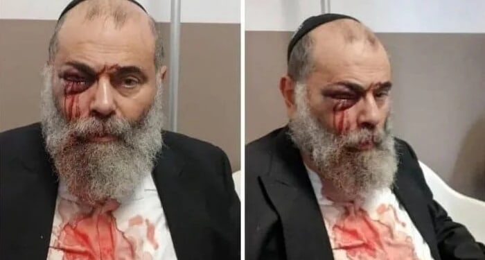 Another Day, Another Jew Assaulted in Europe and Beaten Bloody